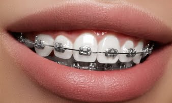 Dental Implants Baulkham Hills