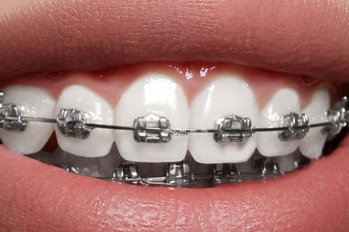 orthodontics-blogimg