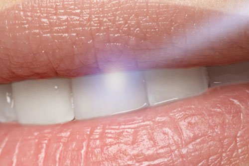 laser-dentistry-blog-pic