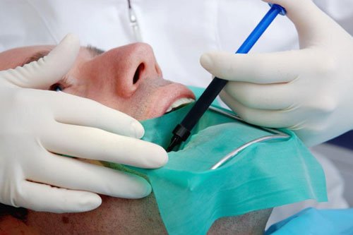 Root-Canal-Surgery