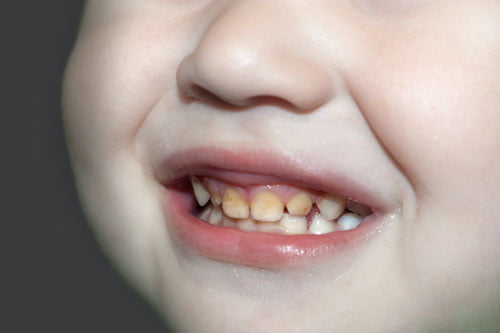 To-Tooth-Decay-In-Young-Children
