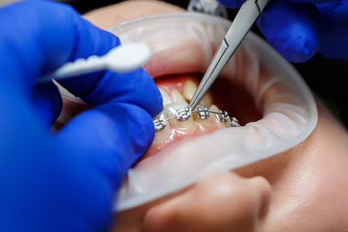 Orthodontic Hygiene Post-Treatment Services