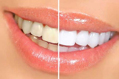 Teeth Whitening Treatments in Baulkham Hills