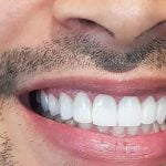 Affordable Porcelain Veneers In Baulkham Hills