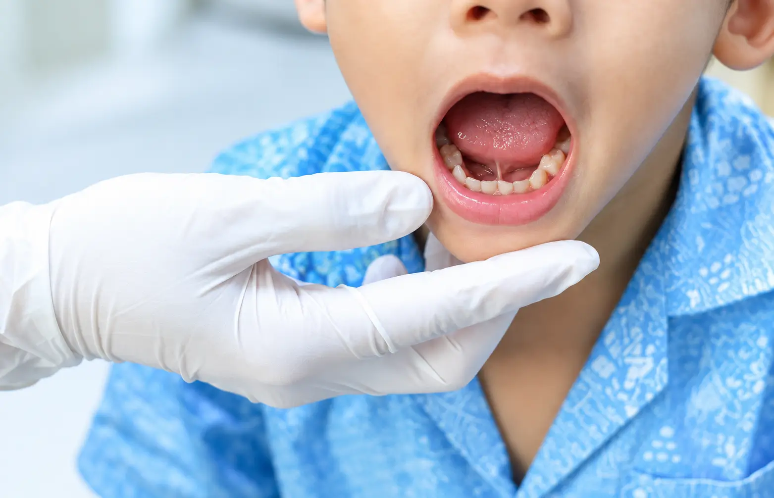 Dental examination showing the frenulum beneath a child’s tongue